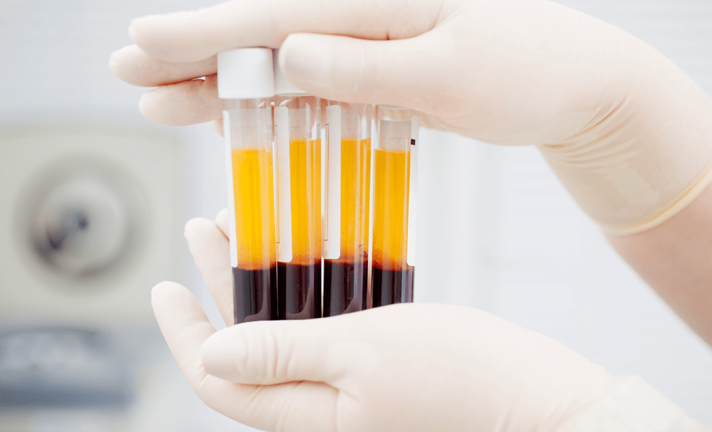البلازما الغنية بالصفائح الدموية لعلاج التهاب المفاصل PRP